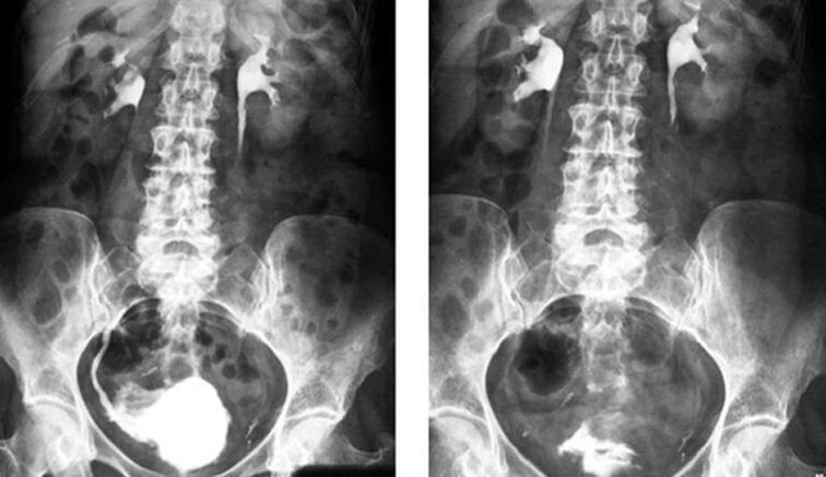 urografia w diagnostyce zapalenia gruczołu krokowego